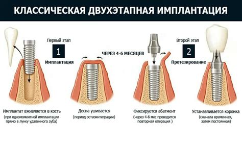 Революция в стоматологии: как имплантация меняет подход к восстановлению зубов